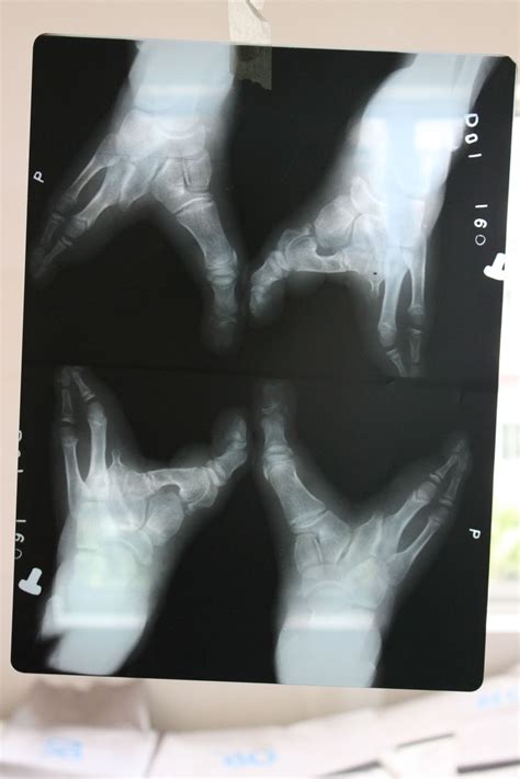 Memorable Case: Ectrodactyly