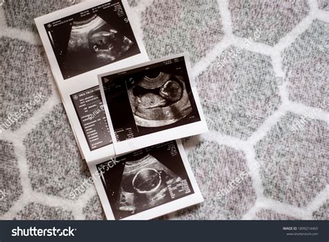 Ultrasound Results Second Trimester Pregnancy Photo Stock Photo 1899214465 | Shutterstock