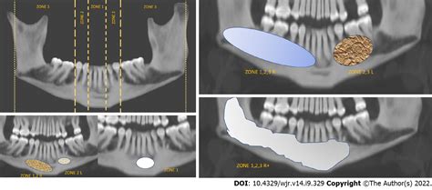 Central Giant Cell Granuloma Radiographic Features