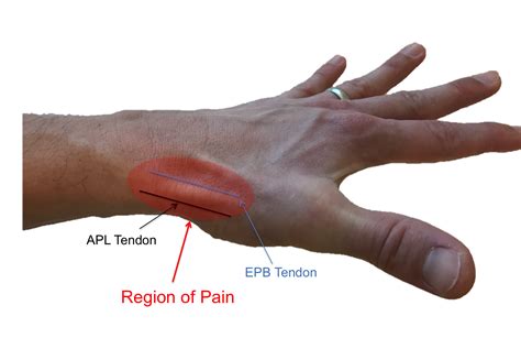 de Quervain Tendonitis - Raleigh Hand Surgery — Joseph J. Schreiber, MD