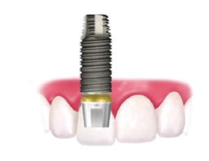 How Do Dental Implants Work? - Hiossen® Implant