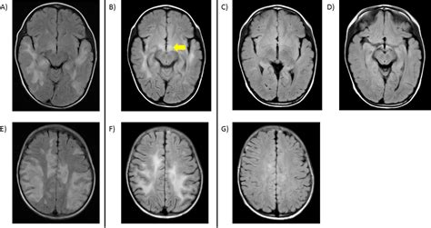 Anti-MOG antibody encephalitis mimicking neurological deterioration in ...