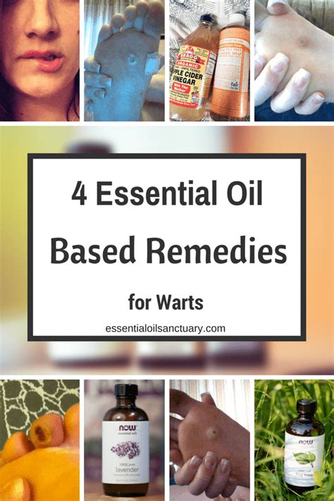 4 Essential Oil Based Remedies for Warts (Verruca)