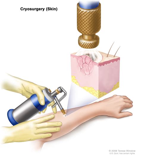 cryoablation (Patient) - Siteman Cancer Center