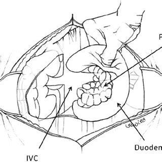 (PDF) A Modern Approach to Teaching Pancreatic Surgery