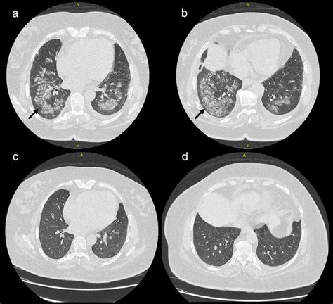 (a, b) Extensive bilateral pulmonary patchy fluffy infiltrates are seen... | Download Scientific ...