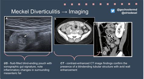 Meckel Diverticulum