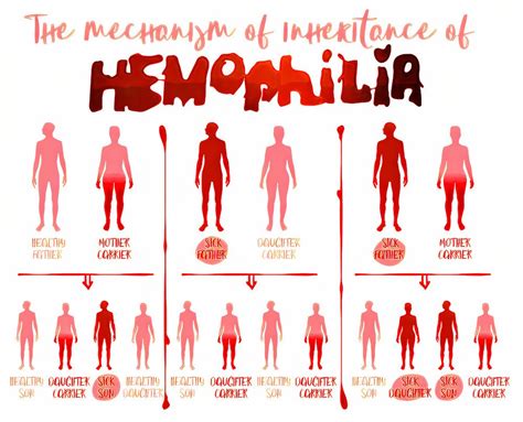 Hemophilia | All You Need to Know About Hemophilia - Page 9 of 16 ...