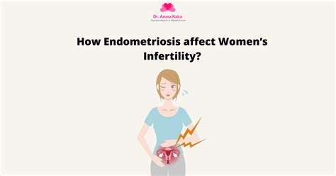 How Endometriosis affect Women Infertility? | Symptoms | Causes | FAQs