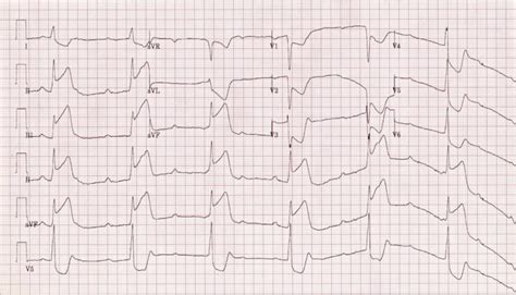 AV block: 3rd degree (complete heart block) • LITFL • ECG Library