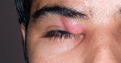 Eye Tumor Treatment in Vadodara by Dr. Surbhi Kapadia