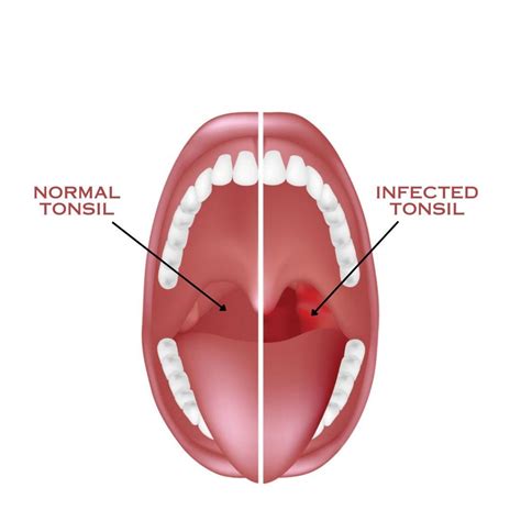 How should I cure my tonsils infection? | by Nidheesh Sarovar | Oct, 2023 | Medium