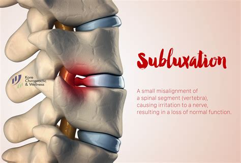 #Subluxation. A small #misalignment of a spinal segment (vertebra), causing irritation to a # ...