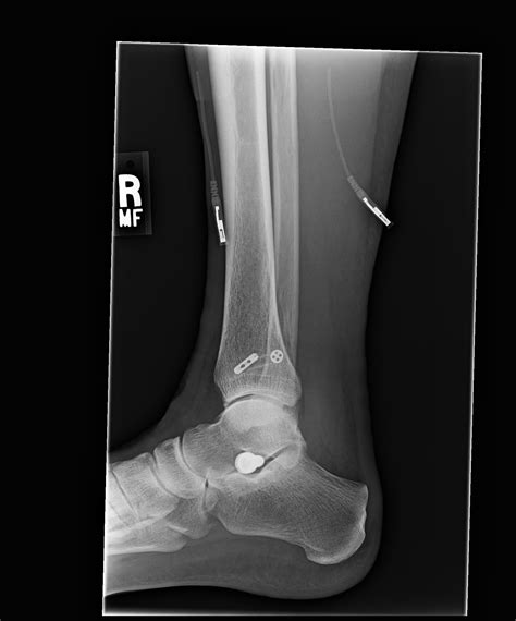 Arthrex TightRope Ankle Fixation with Prior HyProCure Subtalar Joint Stent - SI-Instability.com