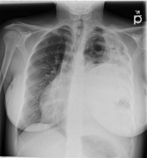 Cystic appearance to left lung with elevated hemidiaphragm. | Download Scientific Diagram