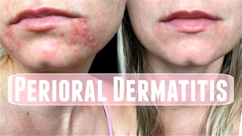 Perioral Dermatitis. How I treated it - YouTube