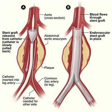 C- Stent Aneurisma aortico – Esquema – Cardiacos.net