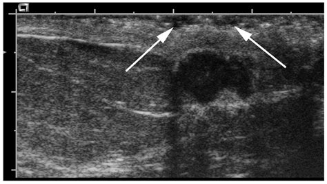 Cancers | Free Full-Text | Retroareolar Carcinomas in Breast Ultrasound ...