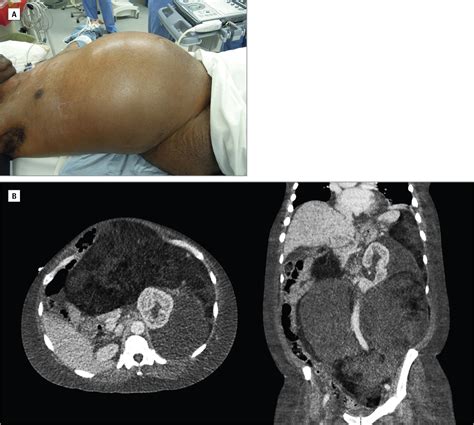 A Man With a Giant Retroperitoneal Mass | Gastroenterology | JAMA ...