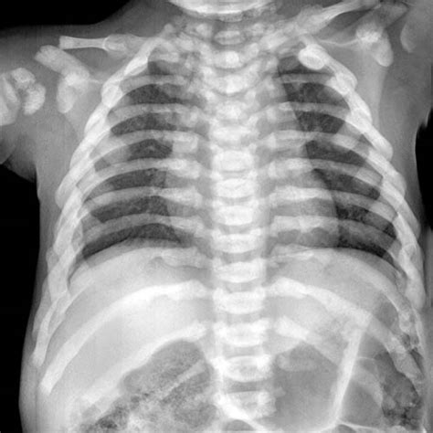 Osteopetrosis | Radiology Key