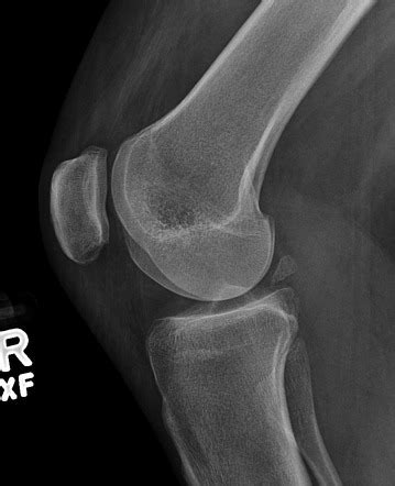 Knee (lateral view) | Radiology Reference Article | Radiopaedia.org