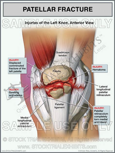 Patellar Fracture of the Left Knee with Torn Retinaculum – Stock Trial Exhibits