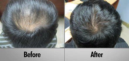 Advanced Laser Hair Therapy - 90% Effective Regrowth Treatment