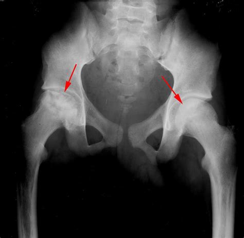 Avascular necrosis of the femoral heads - X Rays Case Studies - CTisus CT Scanning