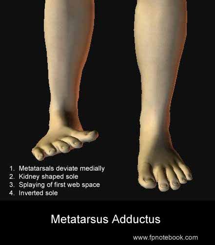 metatarsus adductus - USA News Collections