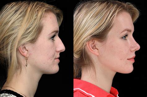 Contouring of the mandible, maxillary advancement and rhinoplasty ...