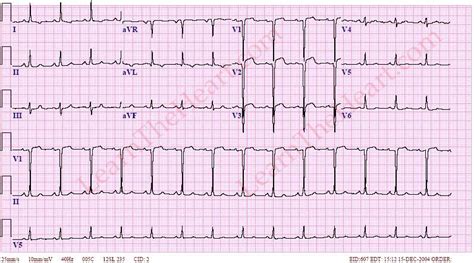 Left Ventricular (LV) Aneurysm ECG | LearntheHeart.com