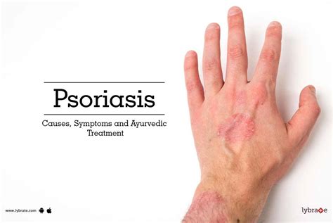 Psoriasis - Causes, Symptoms and Ayurvedic Treatment - By Dr ...