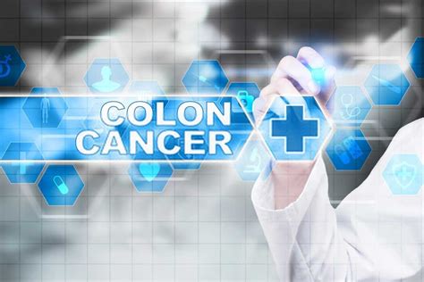 Colon Cancer Prevention: Do These 6 Things and Your Colon Will Thank You - HealthIcu