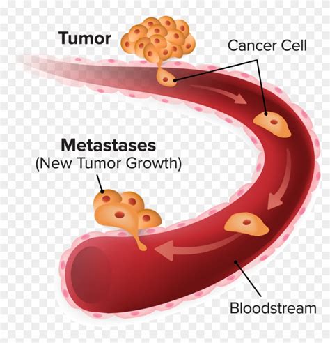 Download Metastasis - Cancer Cell Metastasis Clipart Png Download - PikPng