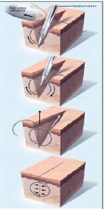 wound closure techniques Flashcards | Quizlet