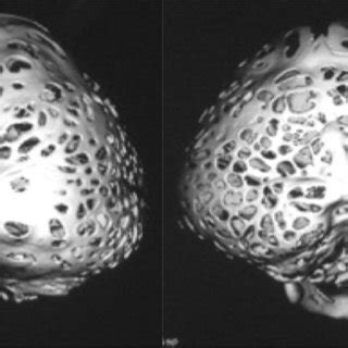 Lateral view of a clinical case of Pfeiffer syndrome type 2. Note the ...