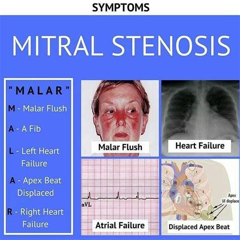 Mitral Stenosis #Medicine #Cardiology #medical #heart #health # ...