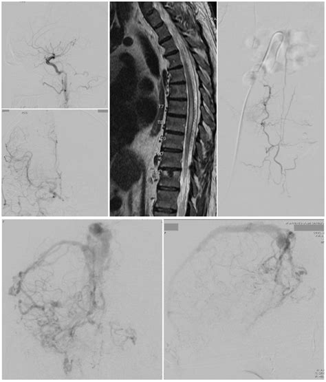 Dural Arteriovenous Fistula - StatPearls - NCBI Bookshelf