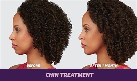 Voluma: FDA Approved Long Lasting Filler for Chin Augmentation – Dr John Burns