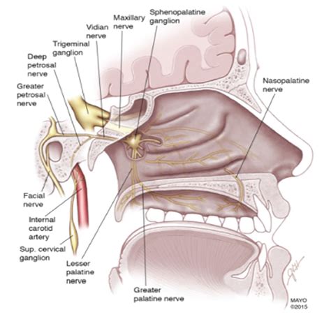 golpear salario Subtropical sphenopalatine ganglion block for pdph Centelleo guirnalda Cabaña