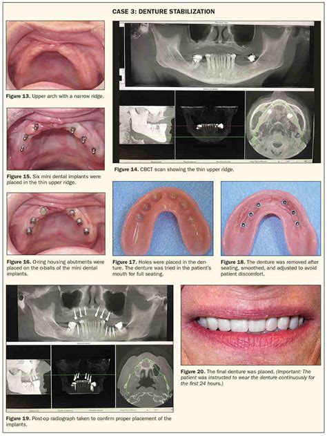 Can mini dental implants be used for upper dentures? - Dental News Network