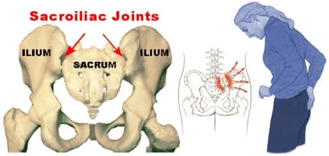 Symptoms of Sacroiliac Pain - Neck Solutions