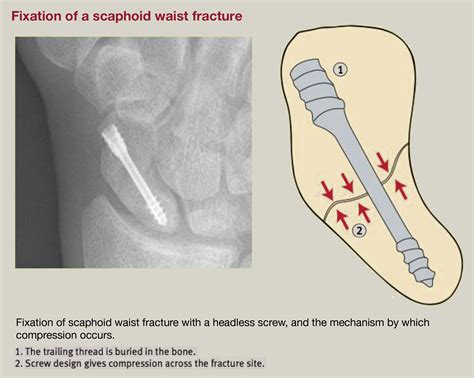 Carpal fractures and dislocations for the MRCS - Surgery - Oxford ...