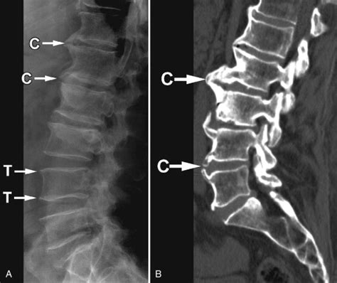 Vertebral Osteophytosis (Spondylosis Deformans) | Radiology Key