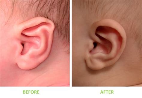 Newborn Ear Correction at Artisan Plastic Surgery | Plastic surgery ...