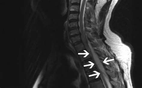 Epidural abscess: Symptoms and management (What to do?)