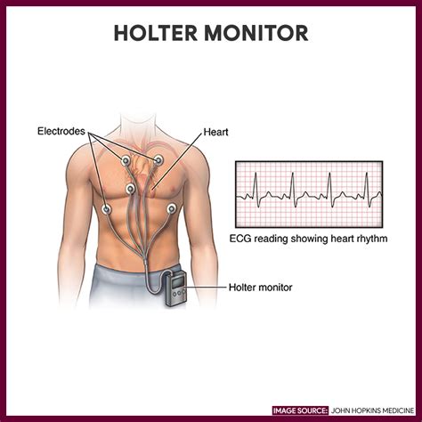 Holter Monitoring - Nursing Responsibilities and Care Plan - Nurseslabs