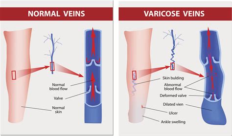 What Causes Venous Pooling? | How to Prevent Venous Pooling?