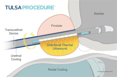 Prostate Cancer Treatment | TULSA PRO - HIFU | SoCal Urology