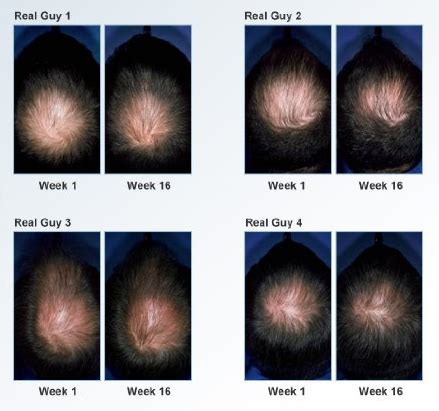 Biotin Hair Growth: Biotin Hair Growth Before And After